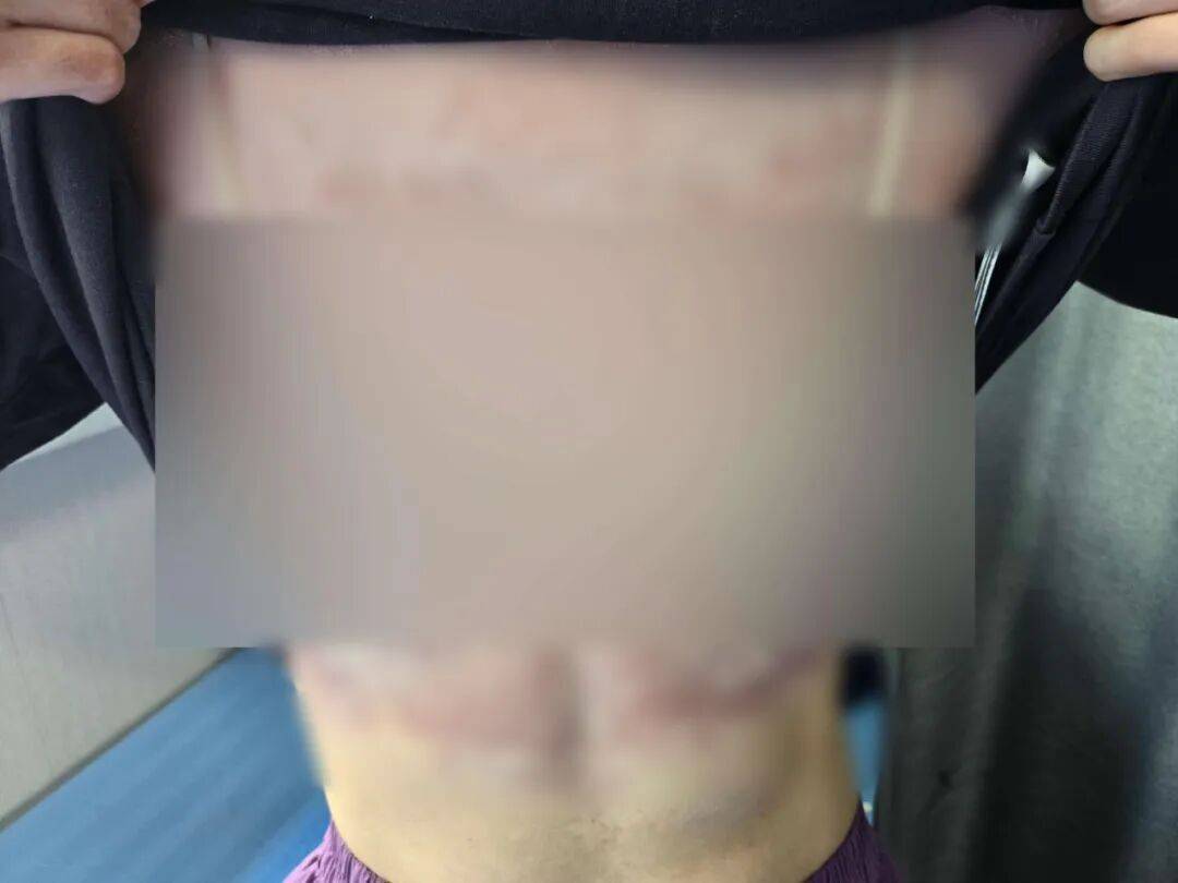 母子相继患“怪病”！红斑爬满全身…元凶很多人在用！