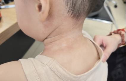 母子相继患“怪病”！红斑爬满全身…元凶很多人在用！