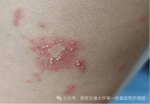 西安多区发现隐翅虫？千万别拍！毒液堪比硫酸