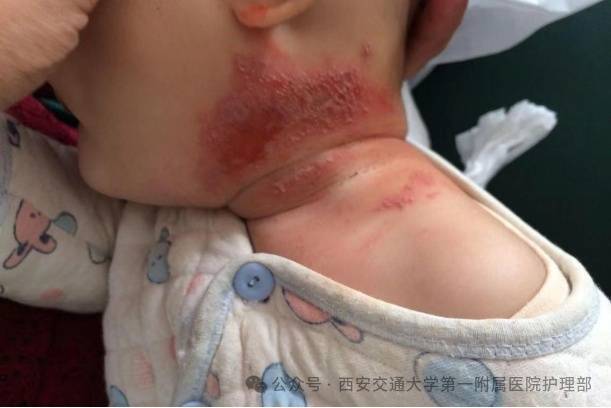 西安多区发现隐翅虫？千万别拍！毒液堪比硫酸